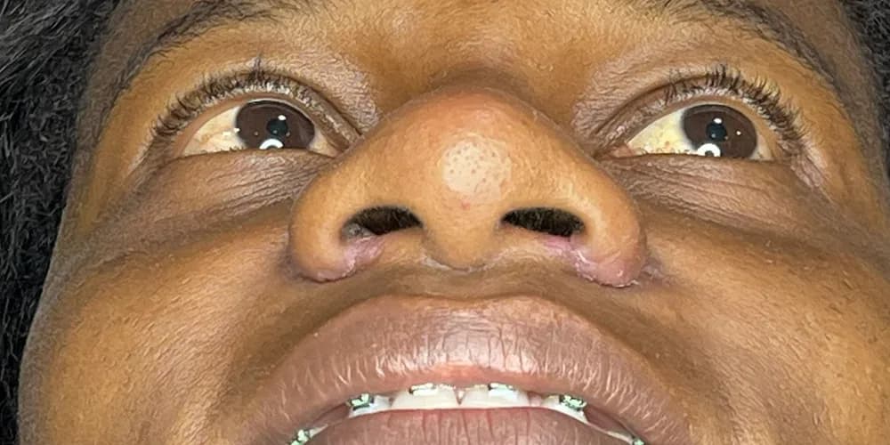 Base nasal armonizada — después