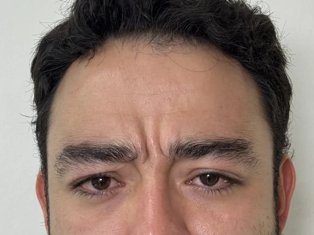 Entrecejo liso al fruncir — antes