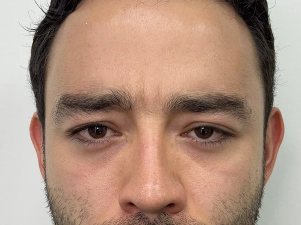 Entrecejo liso al fruncir — después