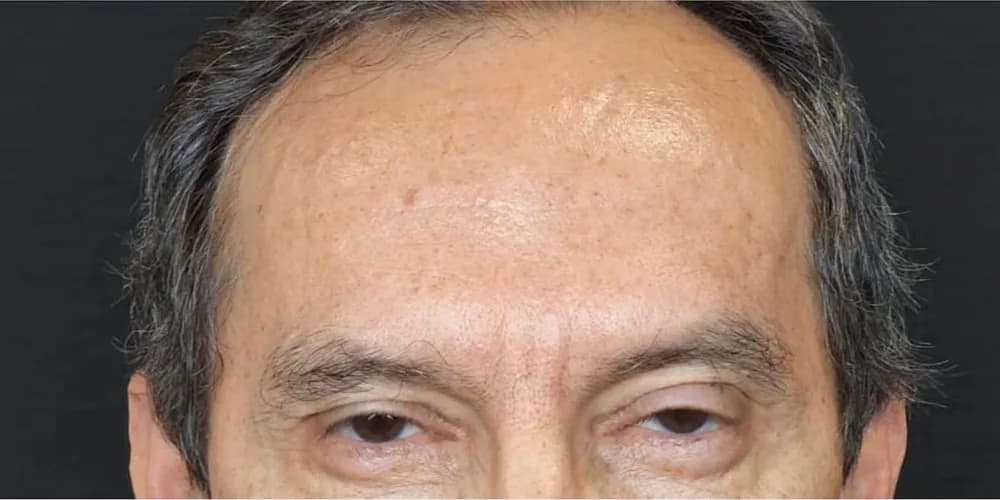 Entrecejo sin líneas de expresión marcadas — después