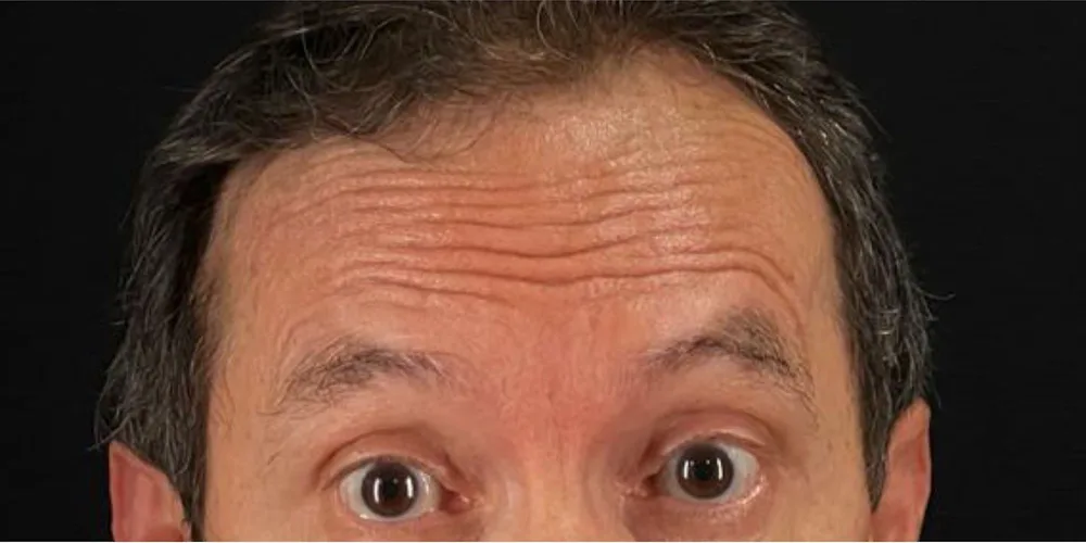 Frente más lisa al levantar las cejas — antes