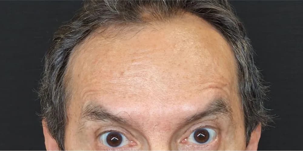Frente más lisa al levantar las cejas — después
