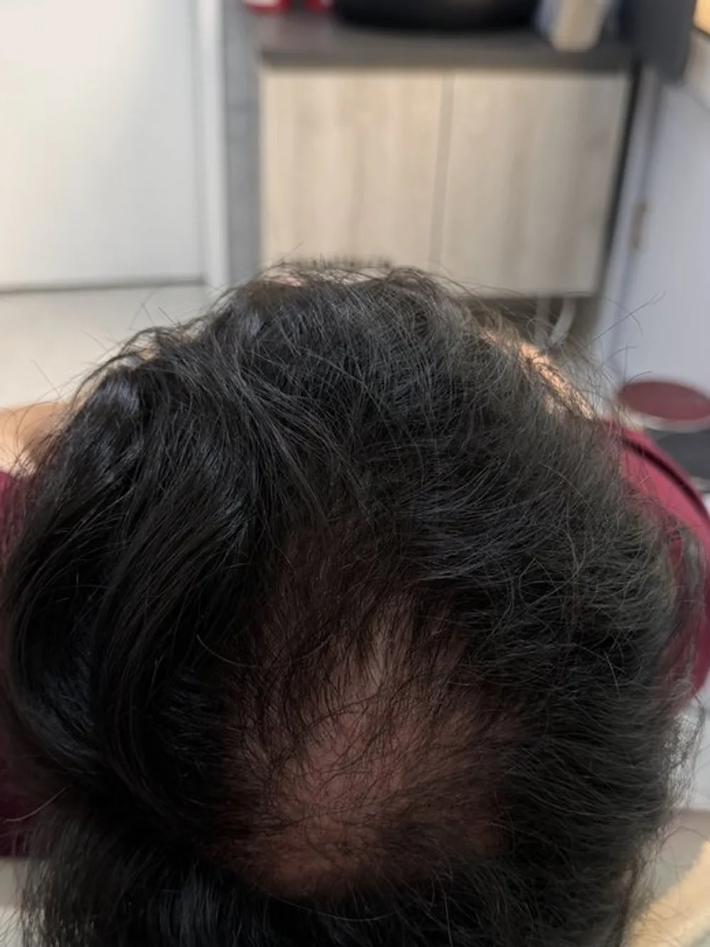Densidad recuperada en la coronilla — después