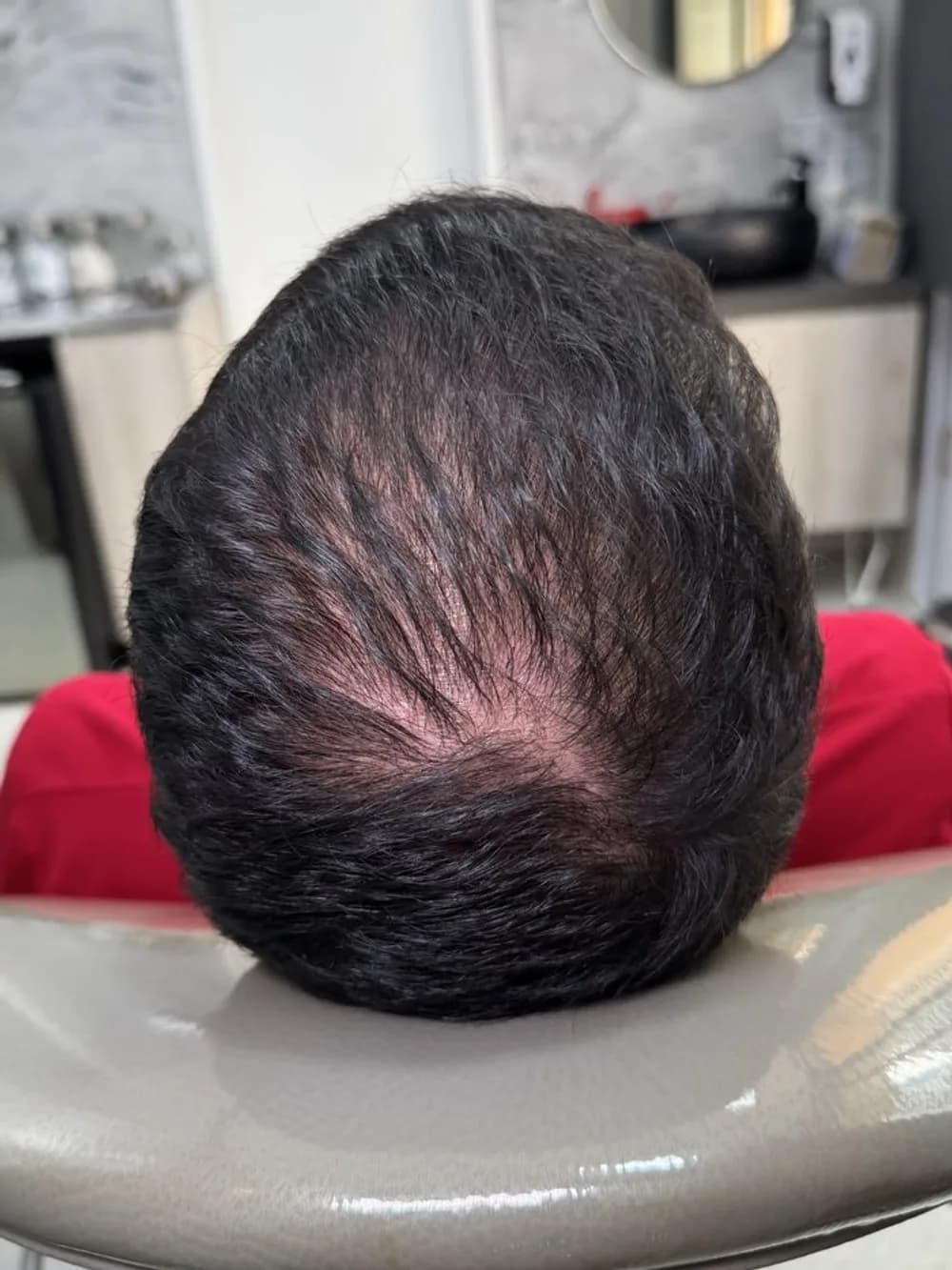 Cabello más denso en la parte superior — antes