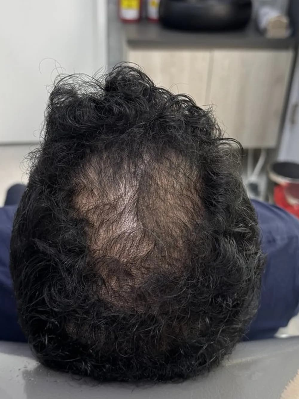 Del claro en la coronilla a un cabello abundante — antes