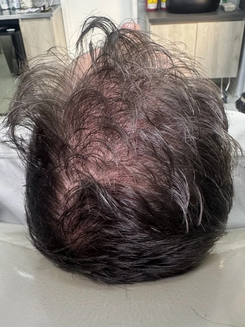 Más cabello y menos brillo del cuero cabelludo — antes
