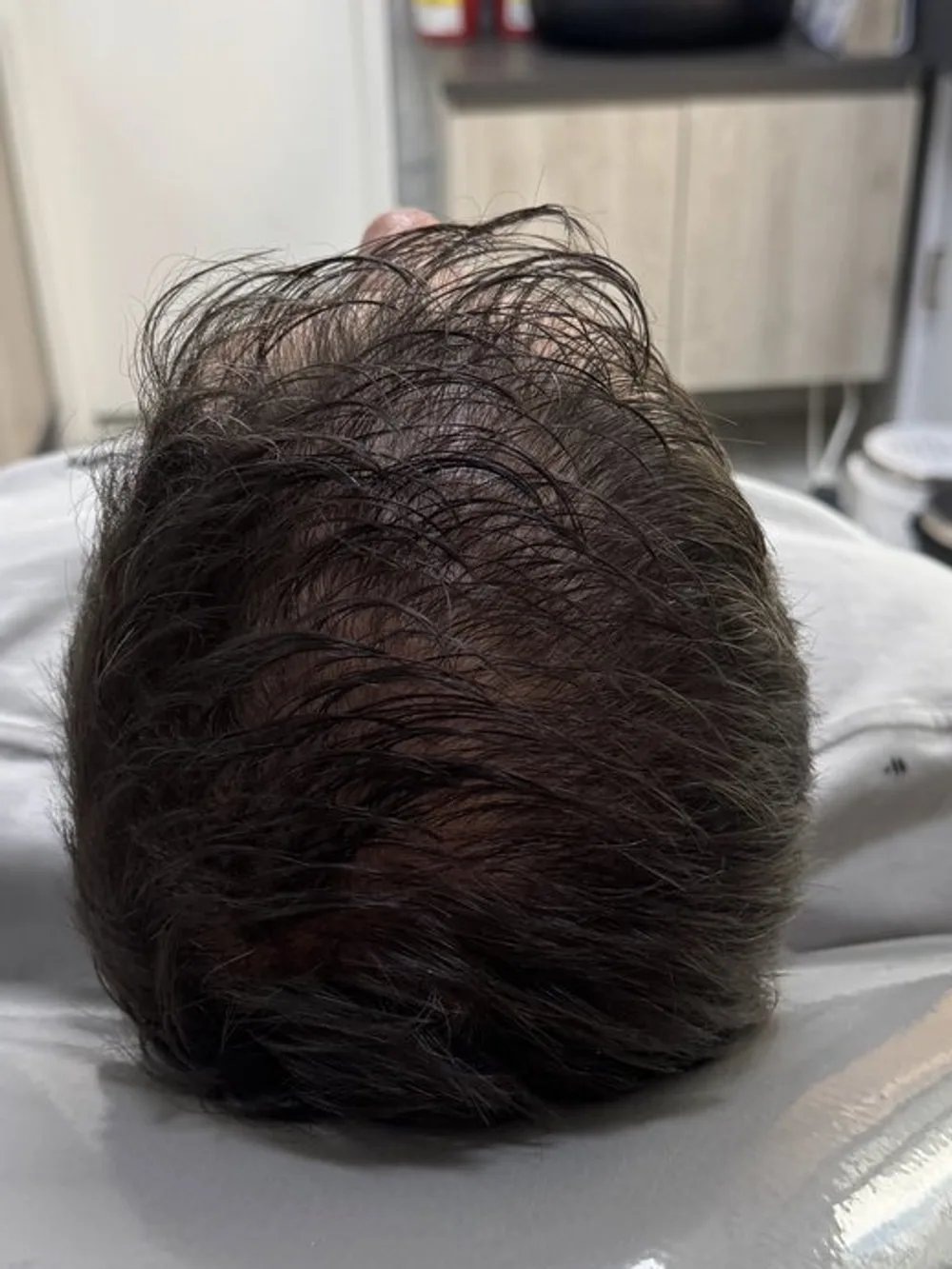 Más cabello y menos brillo del cuero cabelludo — después
