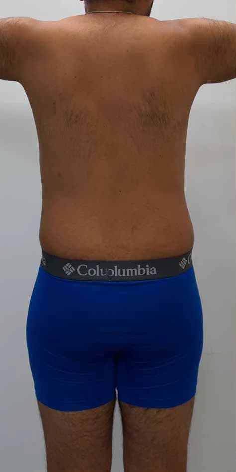 Contorno de espalda y flancos — antes