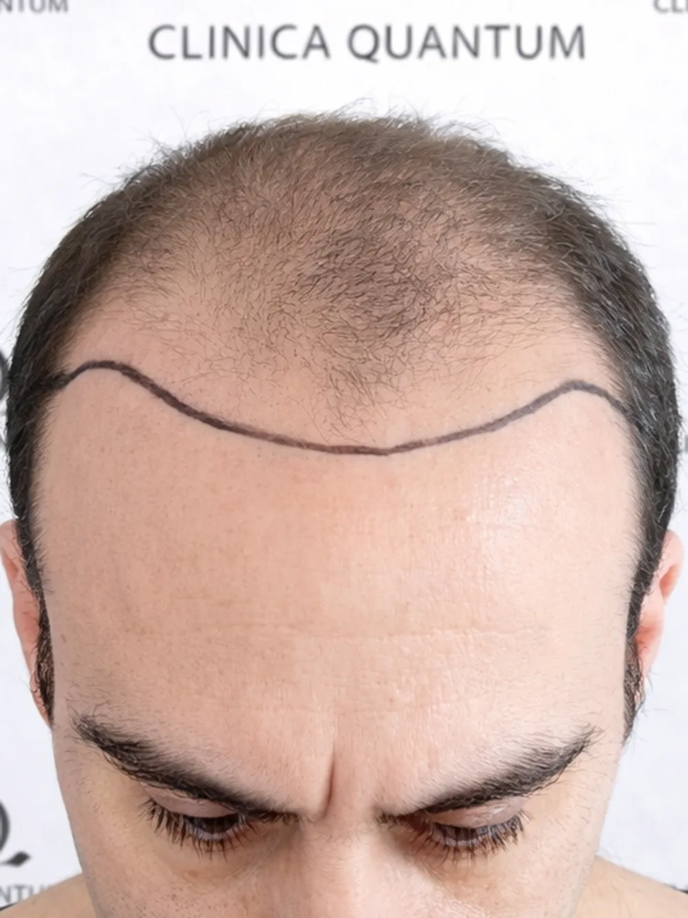 Nueva línea frontal — antes