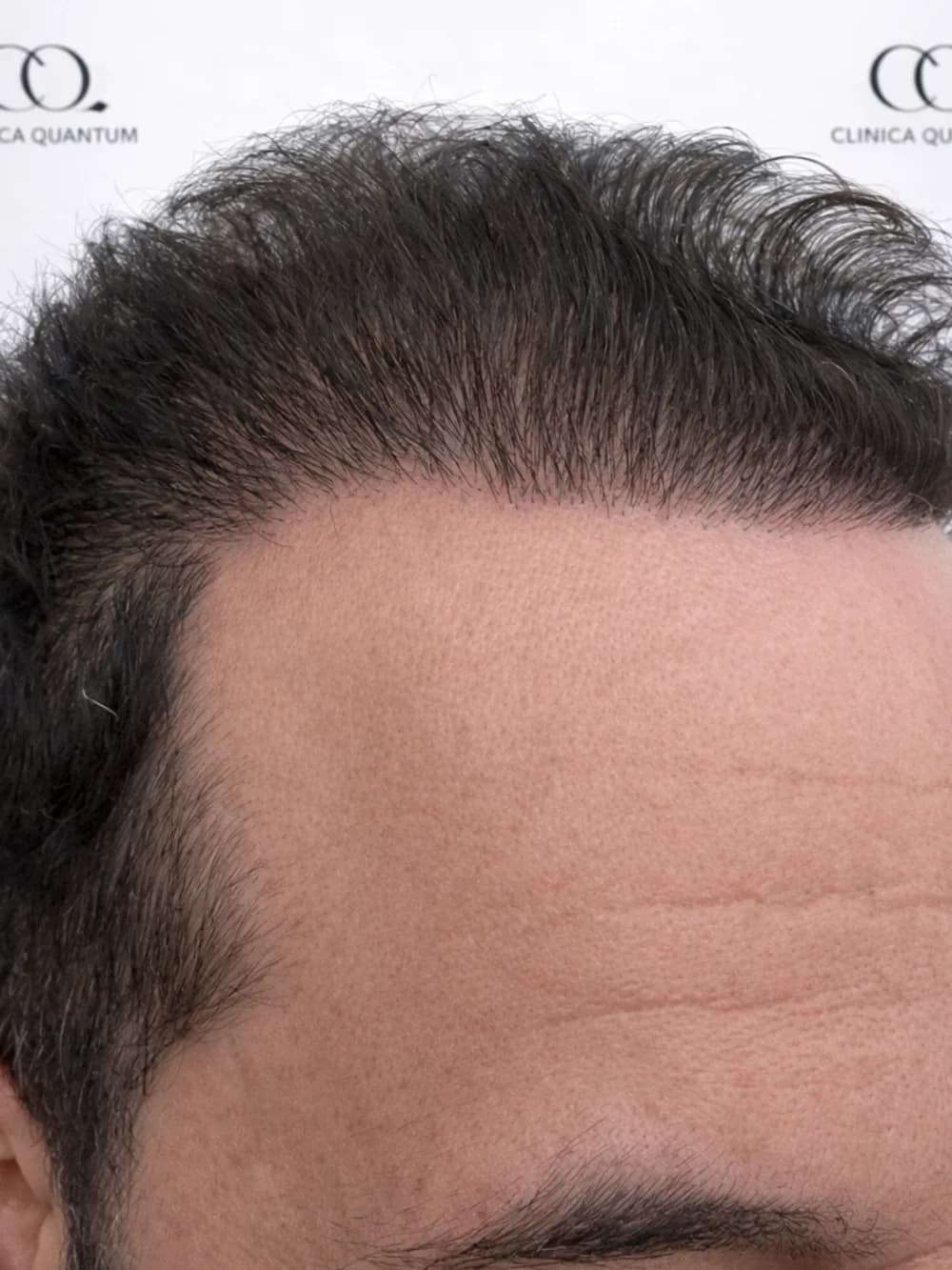 Nueva línea frontal — después
