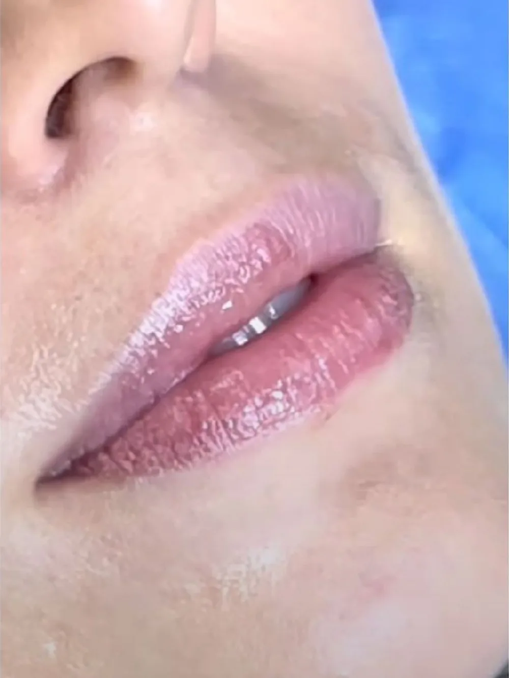 Contorno de labios marcado — antes