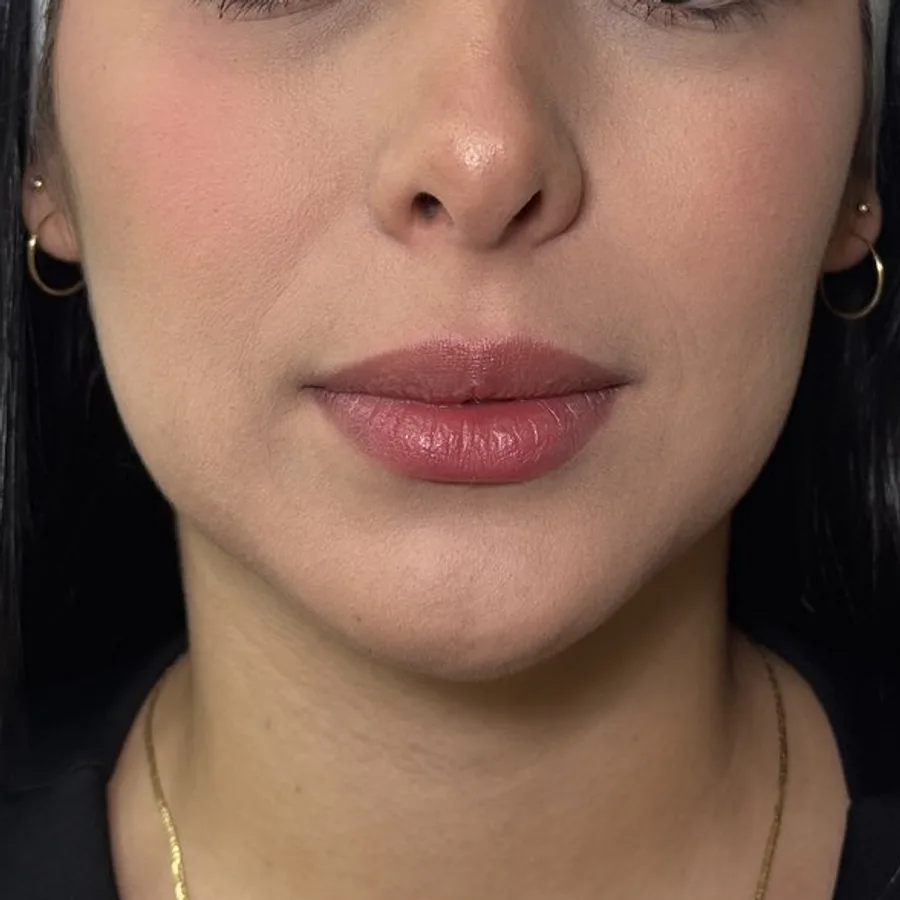 Labios más llenos y naturales — antes