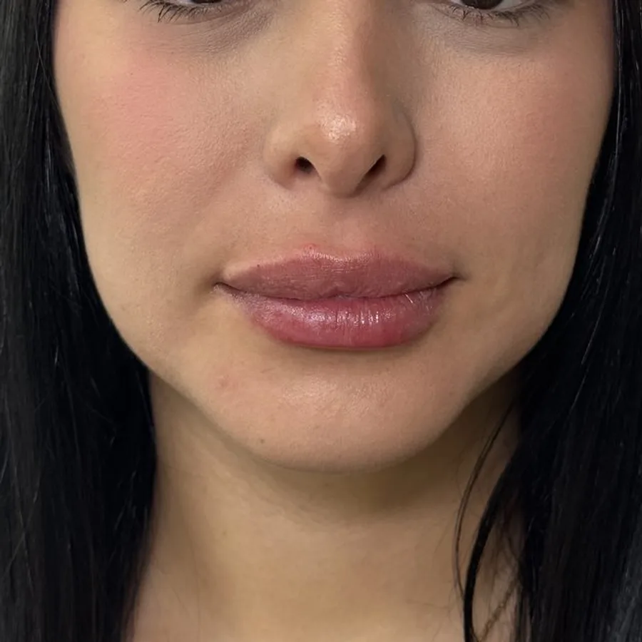 Labios más llenos y naturales — después