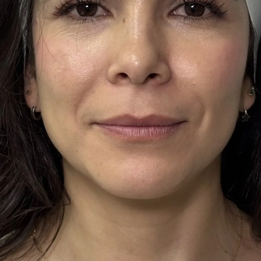Labios hidratados y con forma — antes
