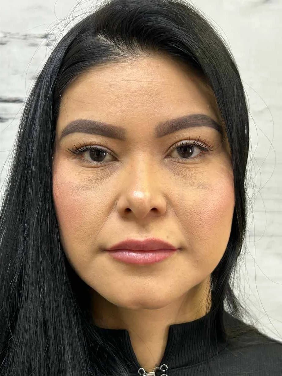 Volumen y contorno labial — antes