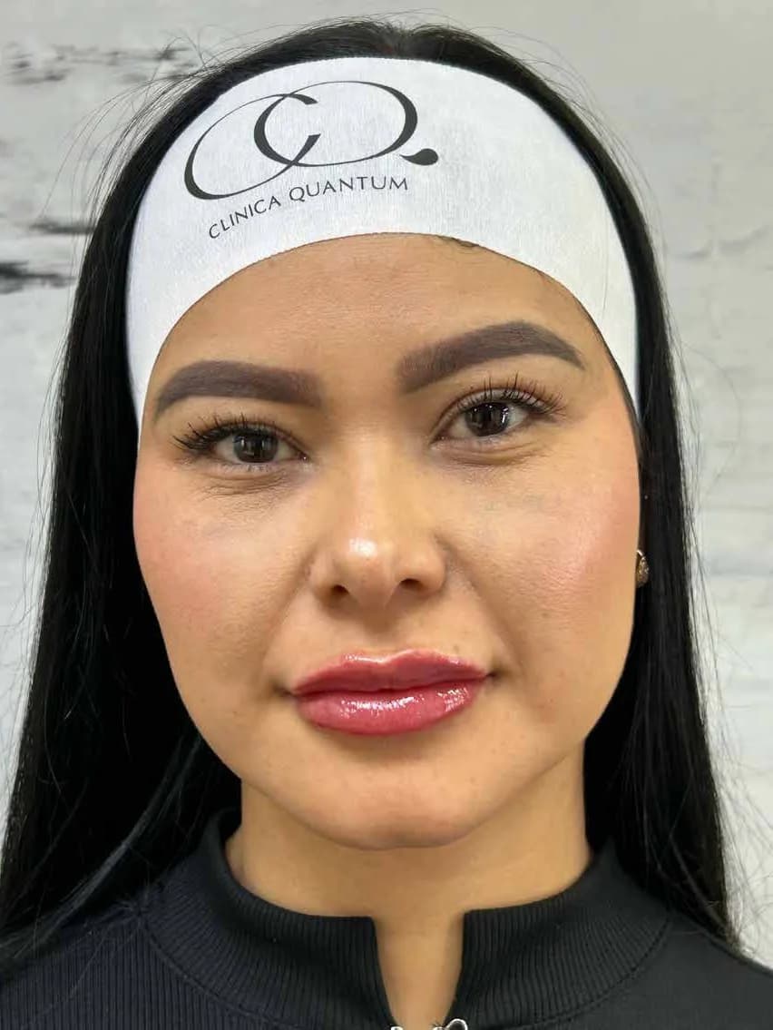 Volumen y contorno labial — después