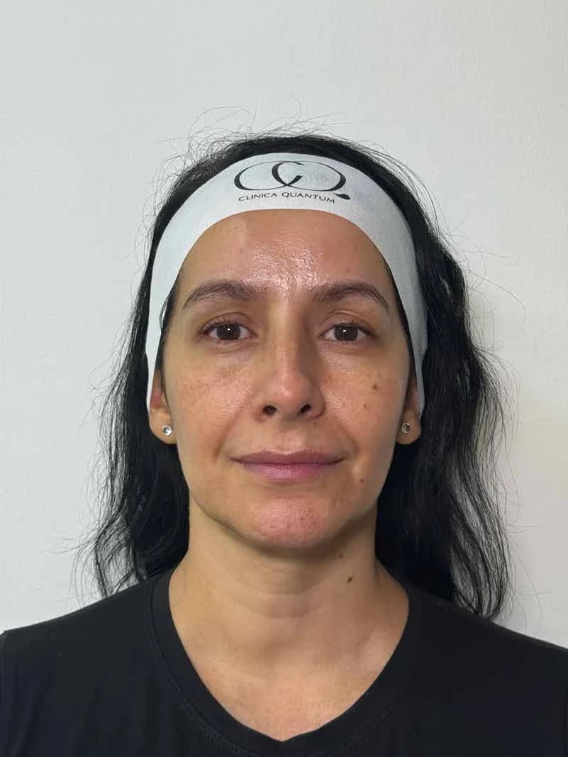 Rejuvenecimiento de rostro y cuello — antes