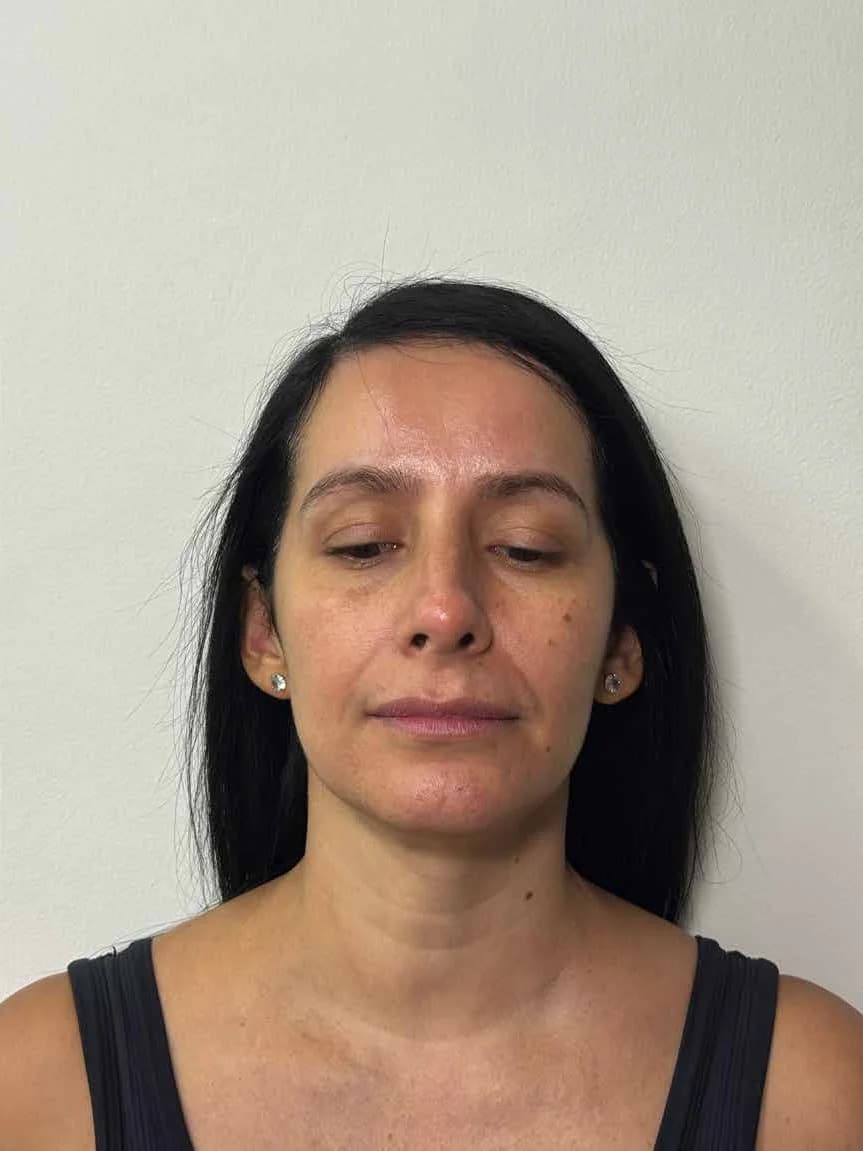 Rejuvenecimiento de rostro y cuello — después