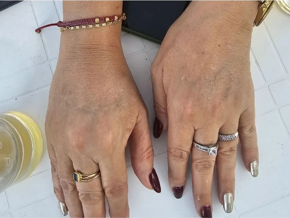 Piel de las manos renovada — después