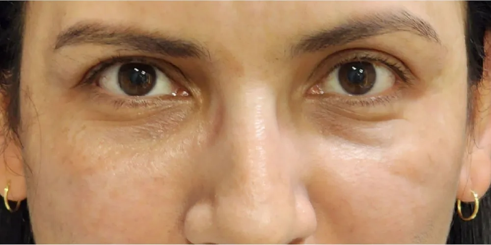 Zona de ojeras más uniforme — antes