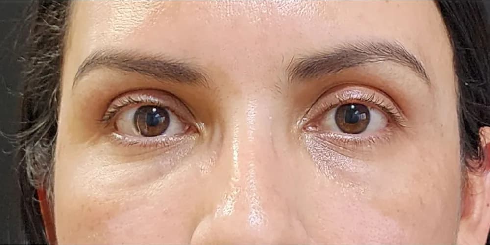 Zona de ojeras más uniforme — después