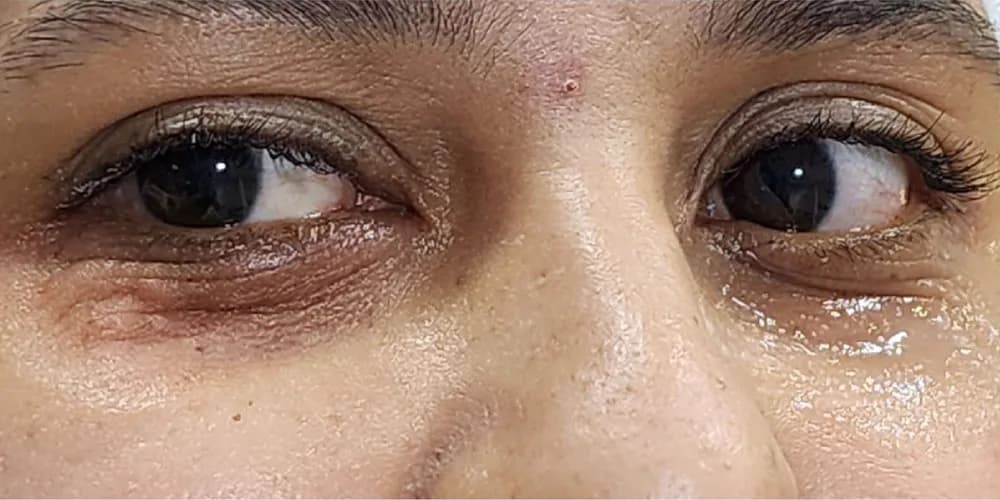 Ojeras menos marcadas — antes