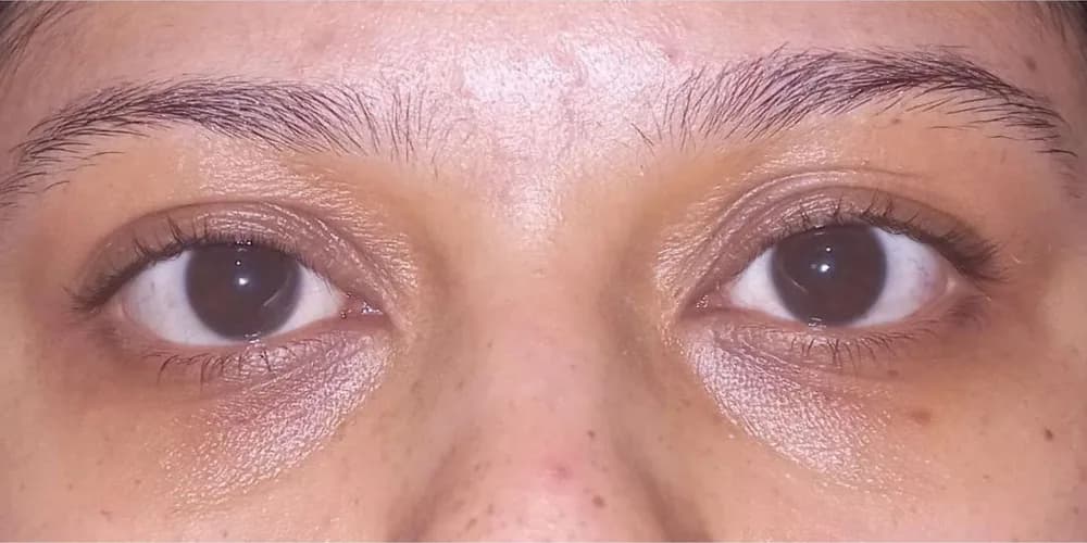 Ojeras menos marcadas — después
