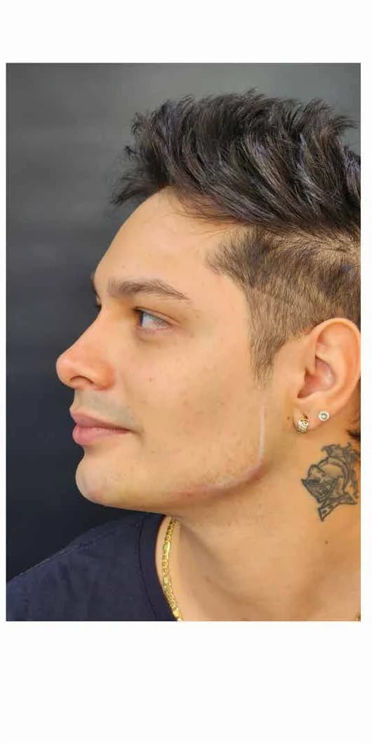 Definición de la línea mandibular — después