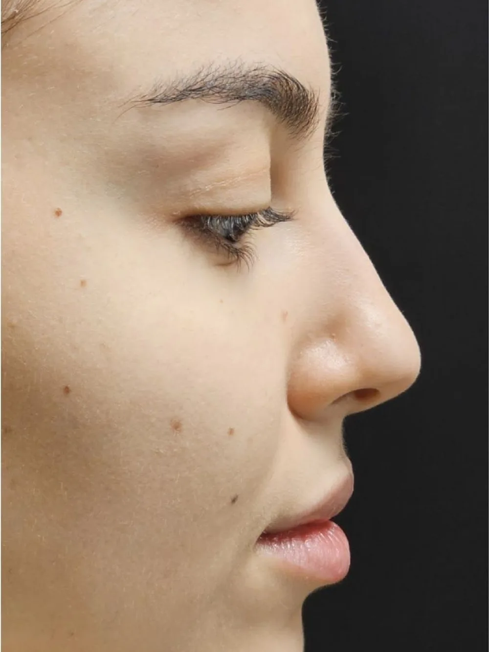 Perfil nasal más armónico — antes