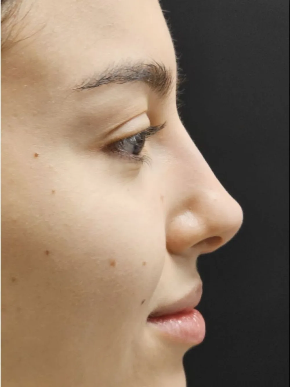 Perfil nasal más armónico — después