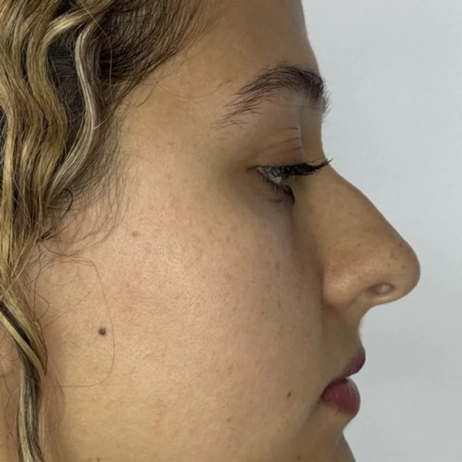 Dorso nasal más recto — antes