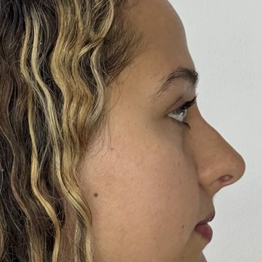 Dorso nasal más recto — después