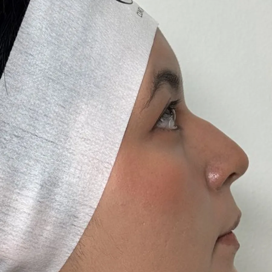 Perfil nasal armonizado — antes