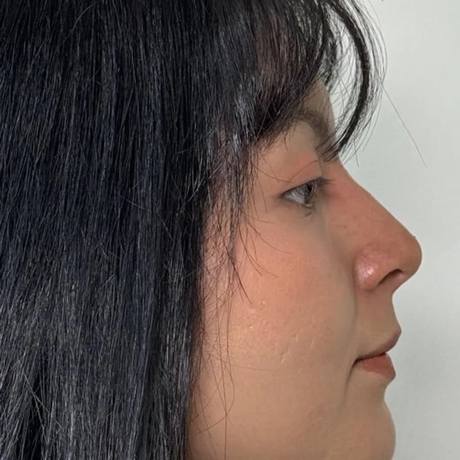 Perfil nasal armonizado — después