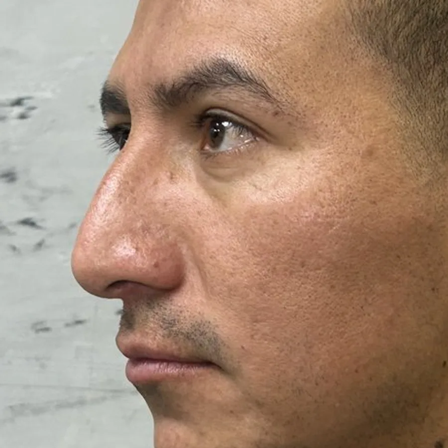 Giba nasal disimulada — antes