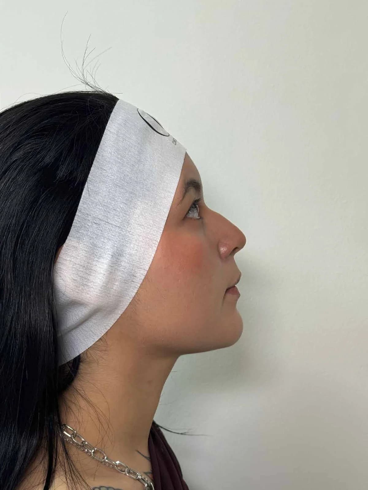 Perfil y punta nasal sin cirugía — antes