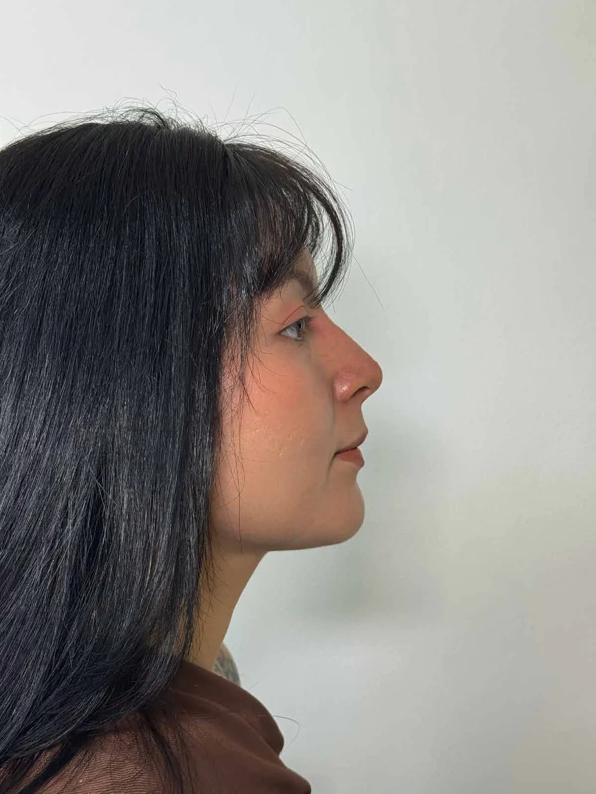 Perfil y punta nasal sin cirugía — después