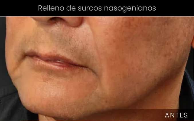 Suavizado de surcos nasogenianos — antes