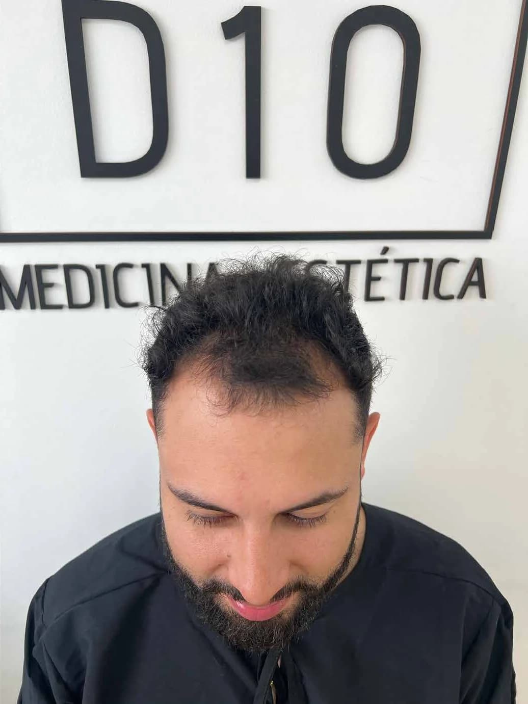 Recuperación de densidad en coronilla — antes