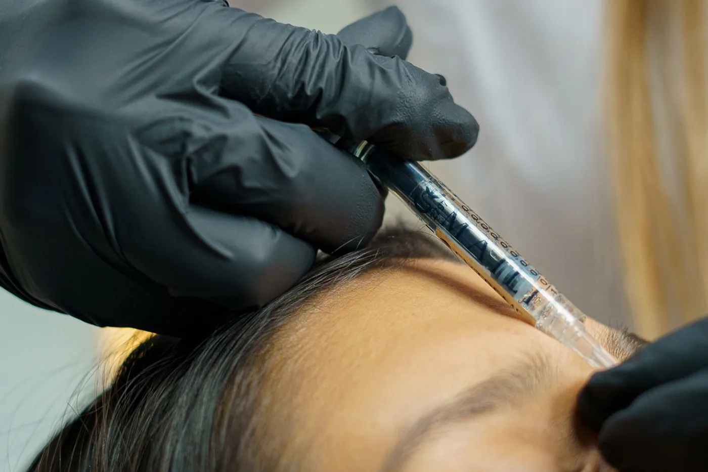 Microinyecciones superficiales: Mesobotox