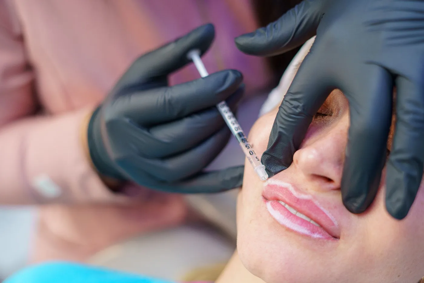 Aplicación: Labios con ácido hialurónico