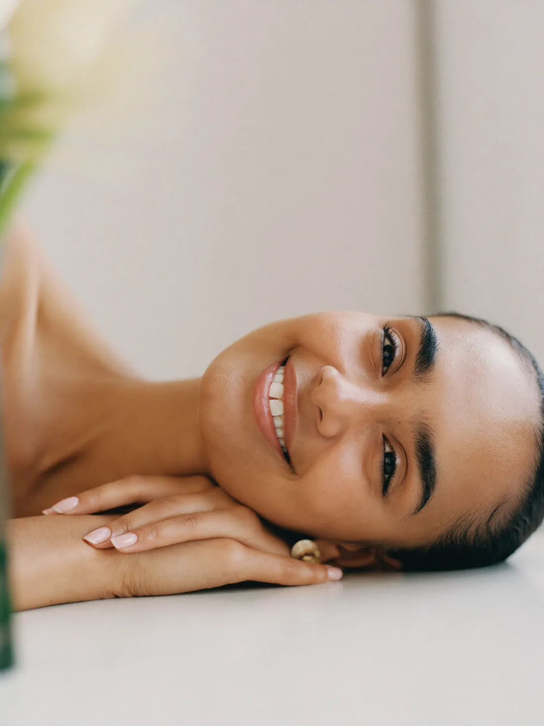Resultado natural de Labios con ácido hialurónico