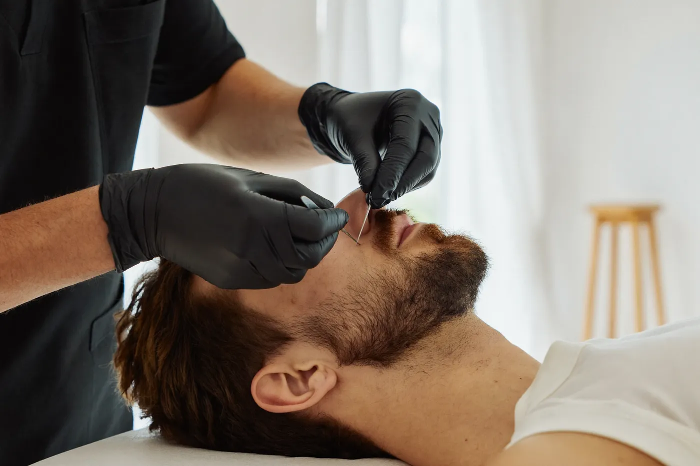 Trasplante de barba: Trasplante de barba